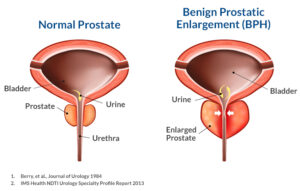 Enlarged Prostate